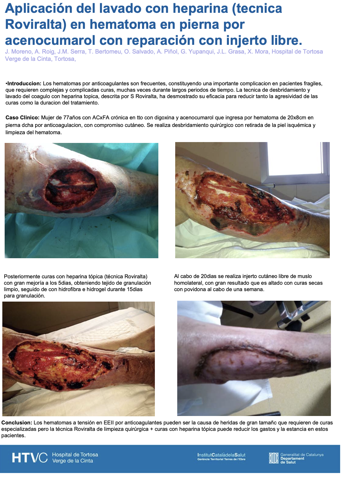 Aplicación del lavado con heparina (tecnica Roviralta) en hematoma en pierna por acenocumarol con reparación con injerto libre.
